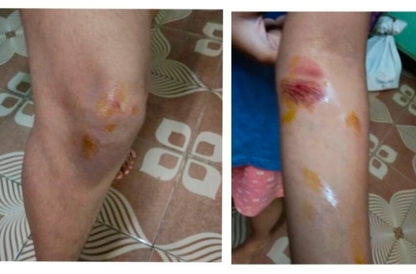  भटक्या कुत्र्यांच्या झुंडीचा विद्यार्थिनीवर हल्ला